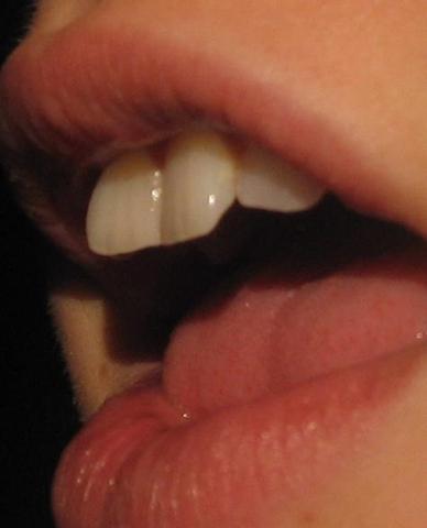 ...meine Zähne von der Seite (da sieht man die Fehlstellung)... - (Gesundheit, Zähne, Zahnarzt)