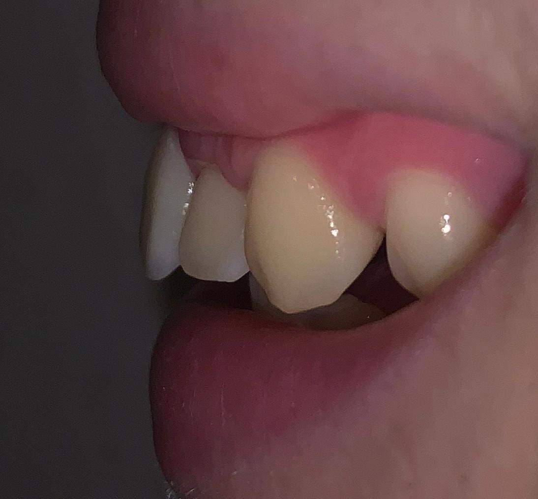 Ich Will Eine Zahnspange Brauche Aber Keine Brauche ich eine Zahnspange? (Zähne)