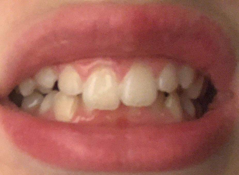 Ich Will Eine Zahnspange Brauche Aber Keine Brauche ich eine Zahnspange? (Zähne, Kieferorthopäde)