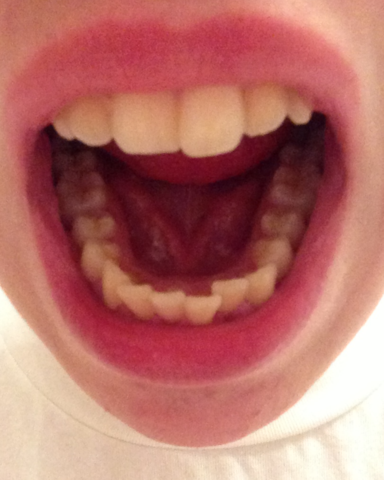 zähne - (Medizin, Zähne, Zahnarzt)