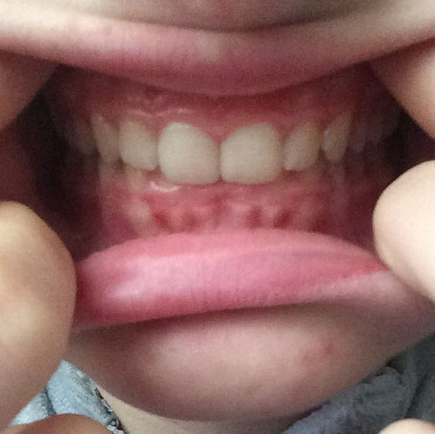 normal Zähne zusammen - (Zähne, Zahnarzt, Zahnspange)