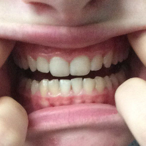 großer Zwischenraum (meine Zunge passt dadurch) - (Zähne, Zahnarzt, Zahnspange)