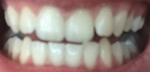 Zahn - (Zähne, Zahnarzt, Zahnspange)