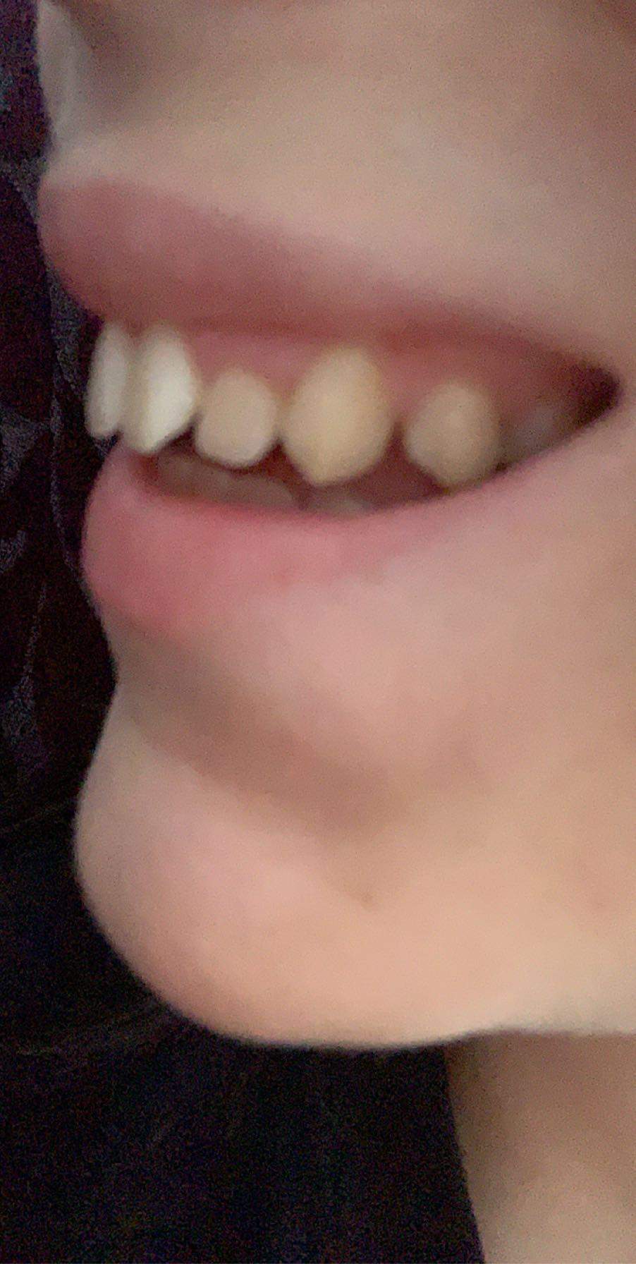 Ich Will Eine Zahnspange Brauche Aber Keine Brauche ich eine Zahnspange unbedingt? (Zähne)