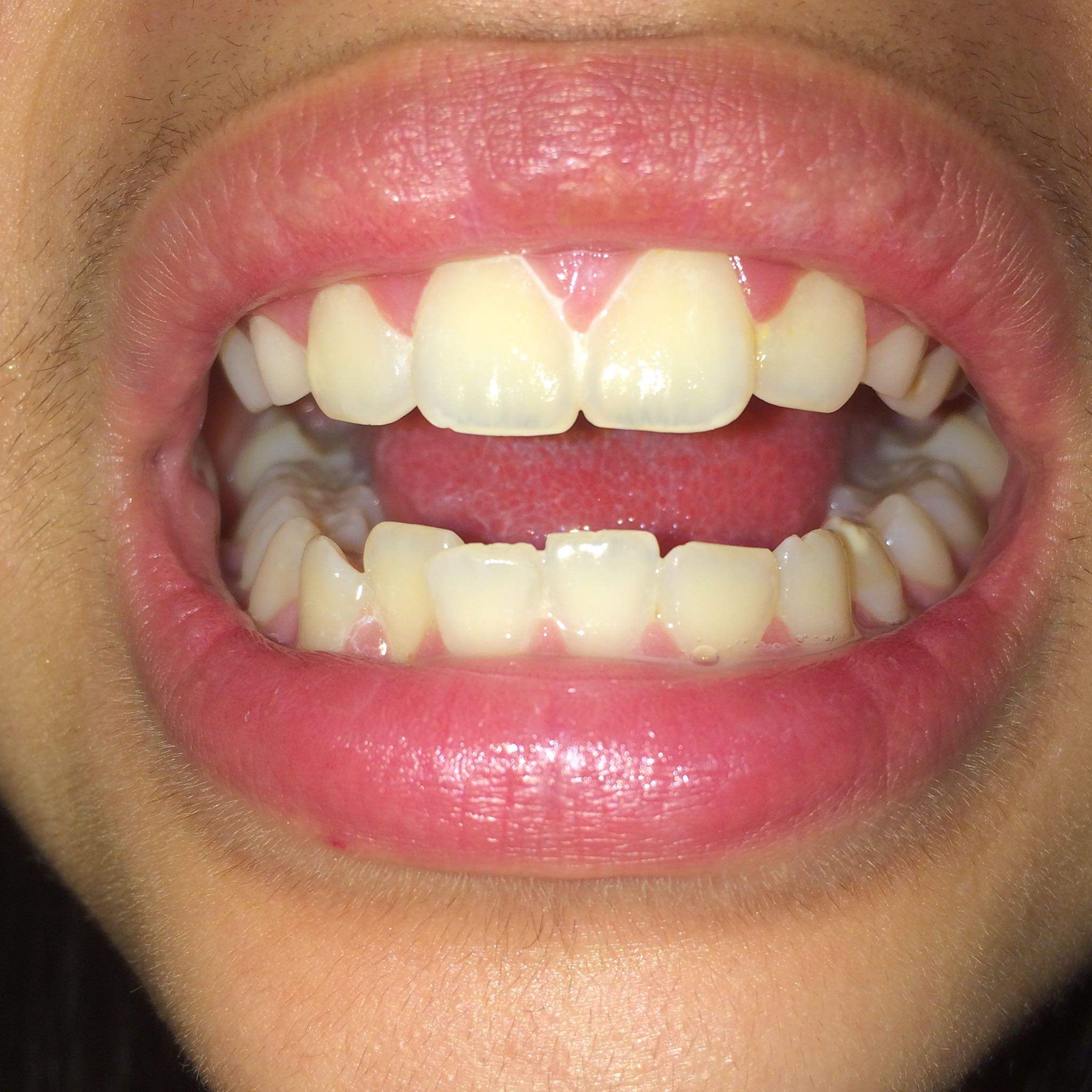 Ich Will Eine Zahnspange Brauche Aber Keine Brauche ich nh zahnspange? (Gesundheit, Zähne)