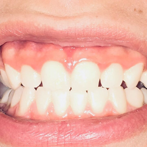 Braucht Diese Person Eine Zahnspange Notig Braucht Diese Person Eine Zahnspange Notig