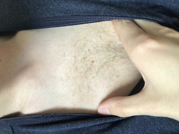 Braune Erhabene Flecken Im Brustbereich Gesundheit Und Medizin Gesundheit Haut Braune Erhabene Flecken Im Brustbereich Gesundheit Und Medizin Gesundheit Haut