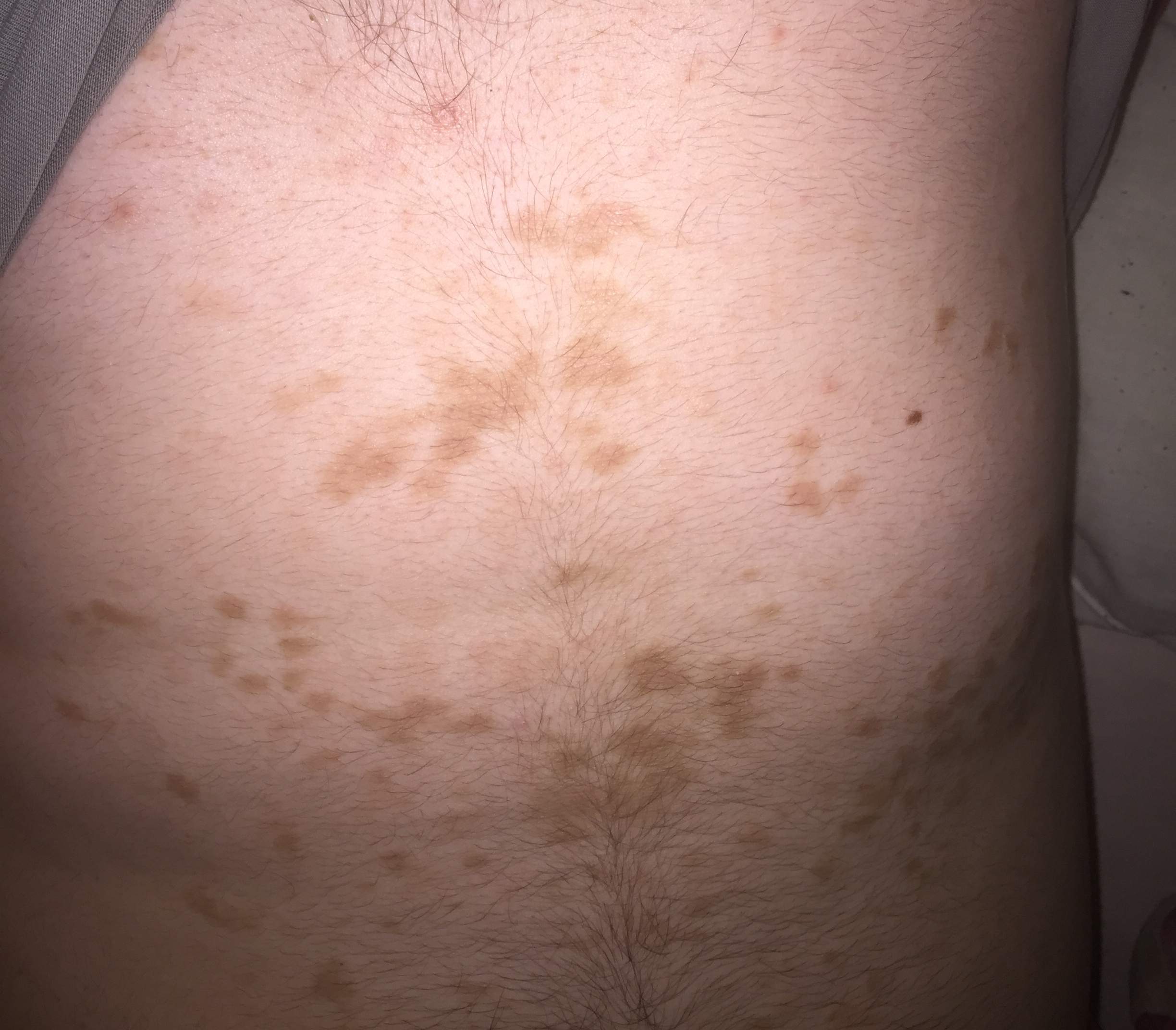 Braune Flecken Am Bauch Hautkrankheit Gesundheit Und Medizin Gesundheit Korper Braune Flecken Am Bauch Hautkrankheit Gesundheit Und Medizin Gesundheit Korper