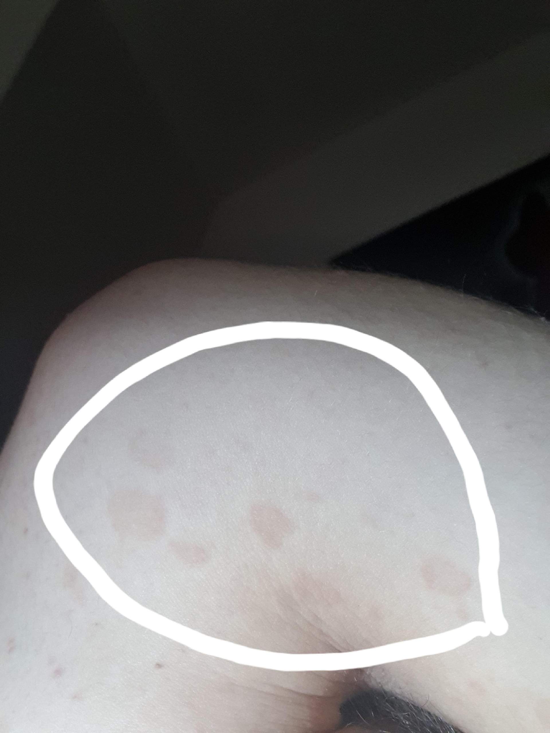 Braune flecken am Brustkorb? (Gesundheit und Medizin)