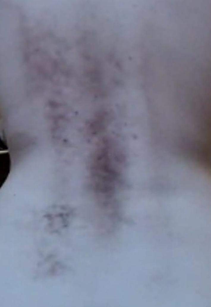 Braune Flecken am Rücken? (Gesundheit, Verbrennung)