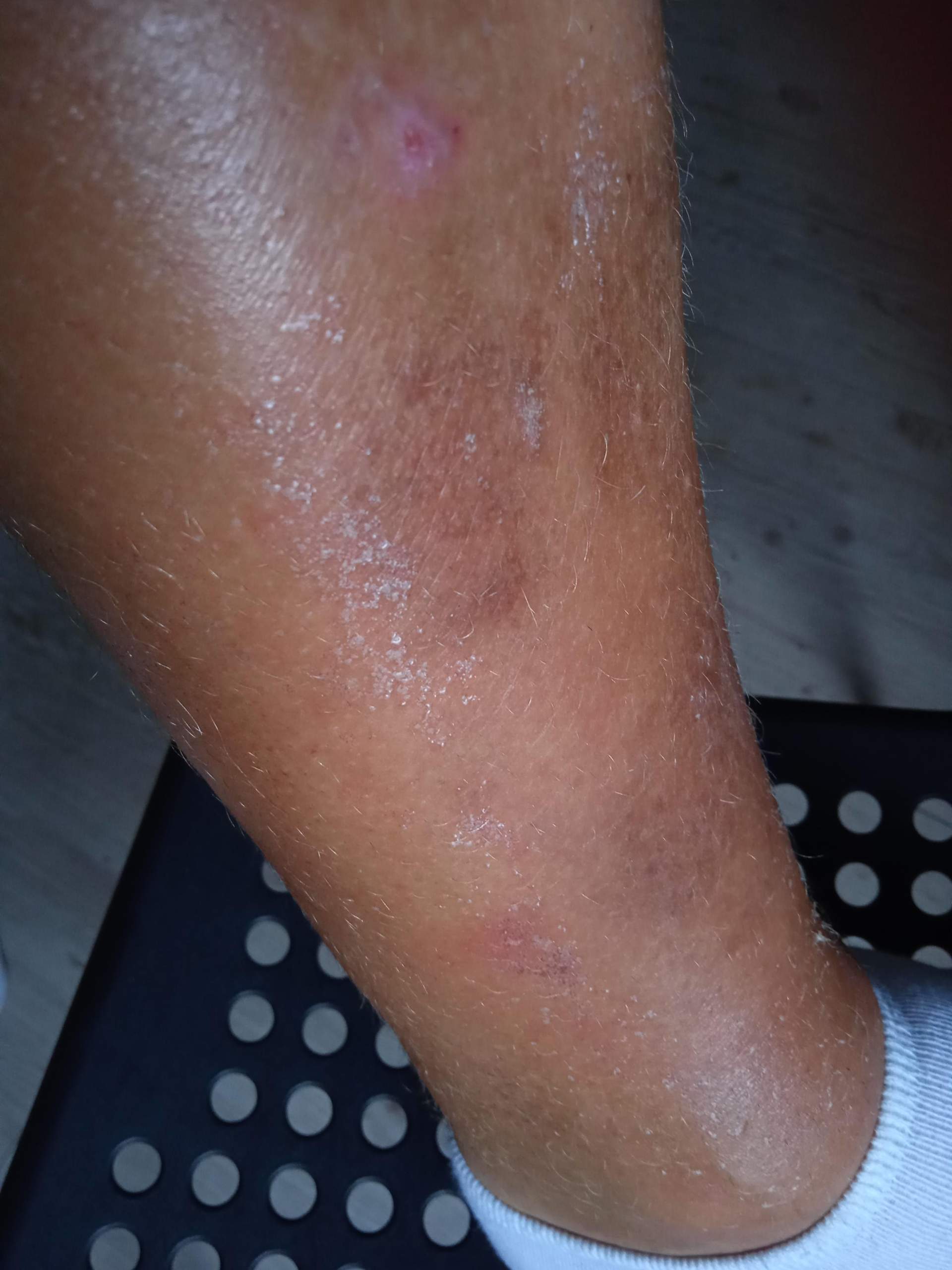 Braune Flecken am Schienbein: Was kann die Ursache sein? (Gesundheit
