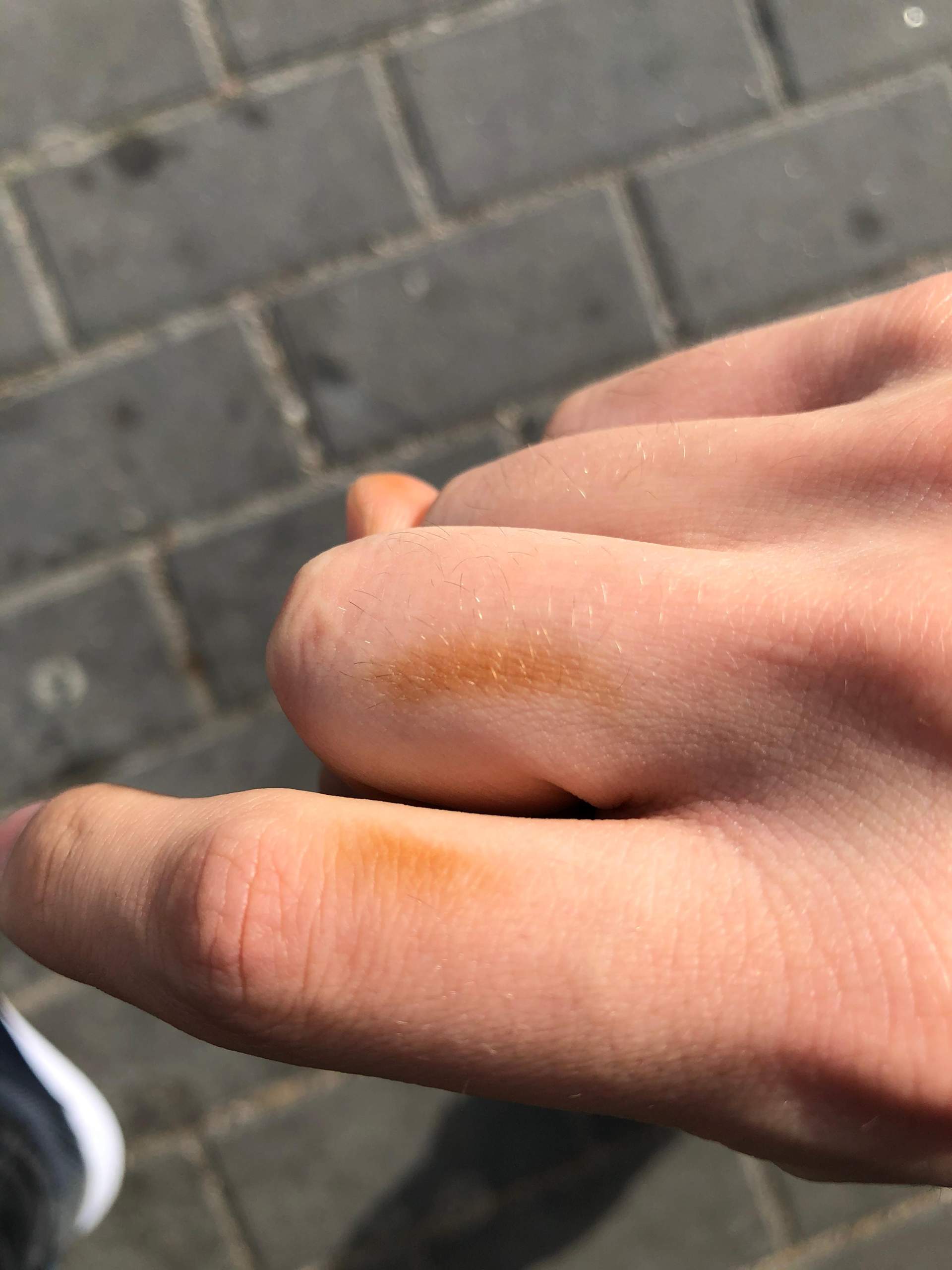 Braune Flecken auf der Hand? (Haut) Braune Flecken auf der Hand? (Haut)
