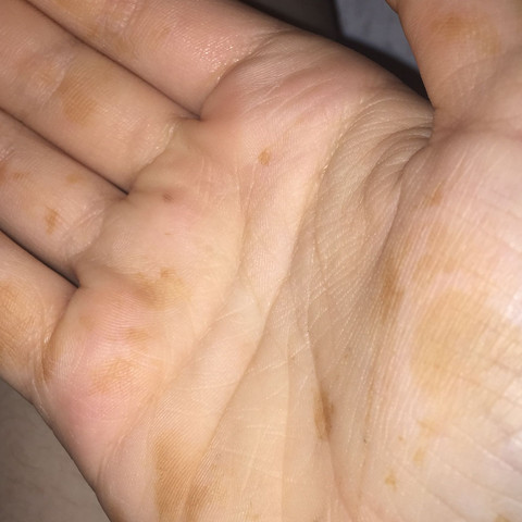 Braune Flecken Auf Der Haut Hand Gesundheit Und Medizin