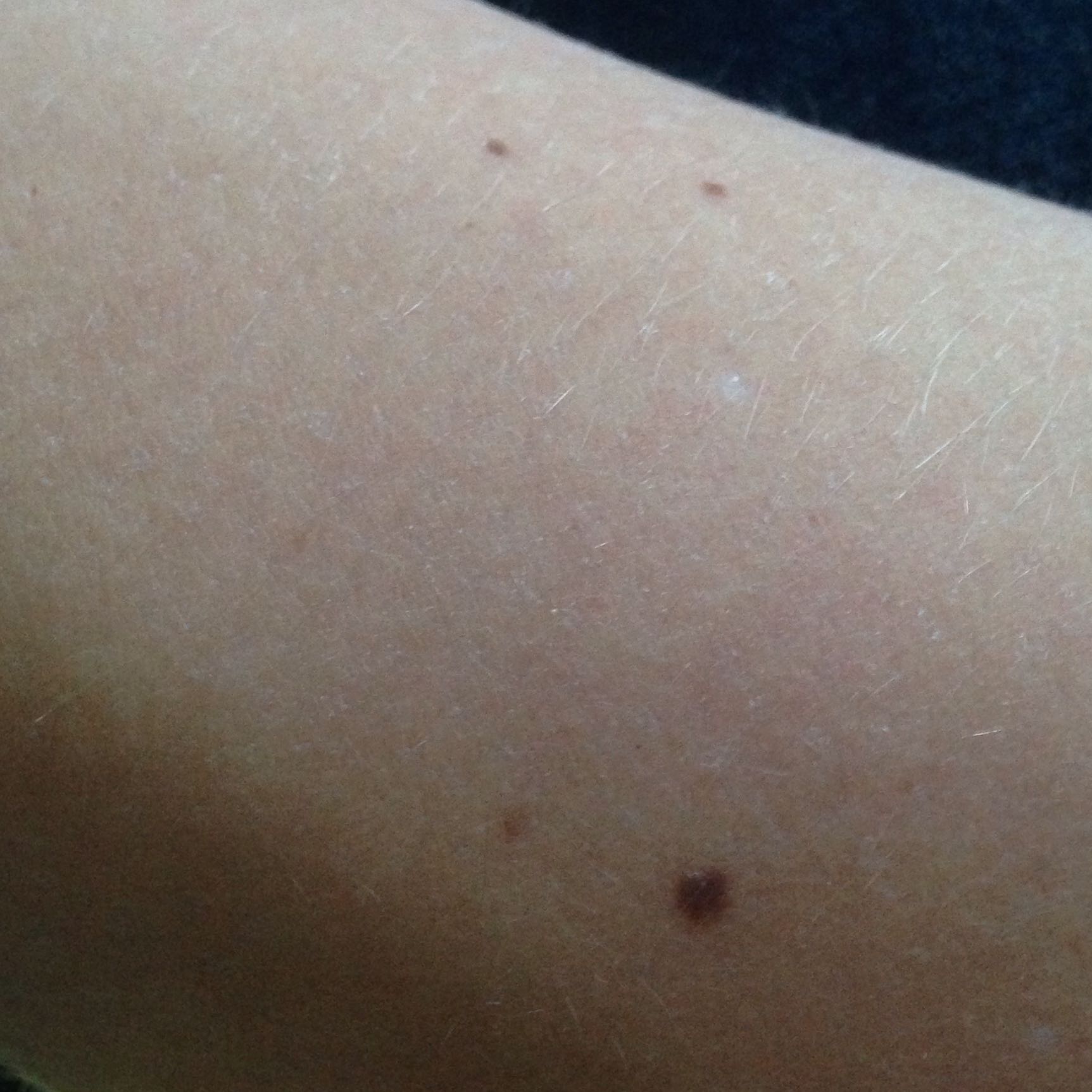 Braune Flecken Auf Der Haut Immer Mehr Muttermal Braune Flecken Auf Der Haut Immer Mehr Muttermal
