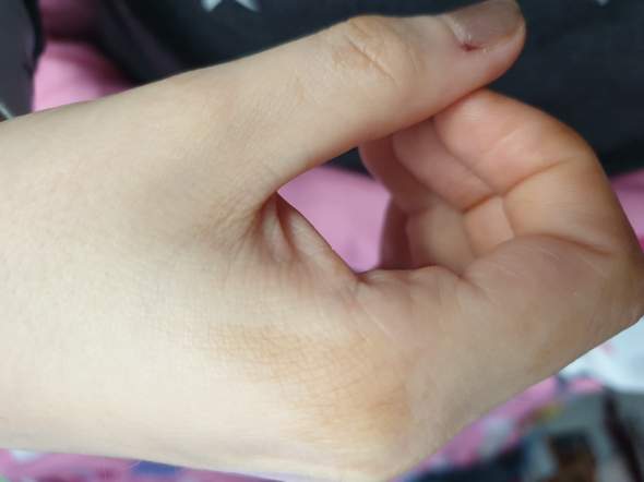 Flecken auf der hand braune Dunkle Haut,