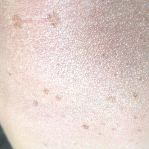 merkwürdige braune Flecken auf meinen Schultern entdeckt und weis nicht woher ?! - (Haut, Sonnenbrand, Hautkrebs)