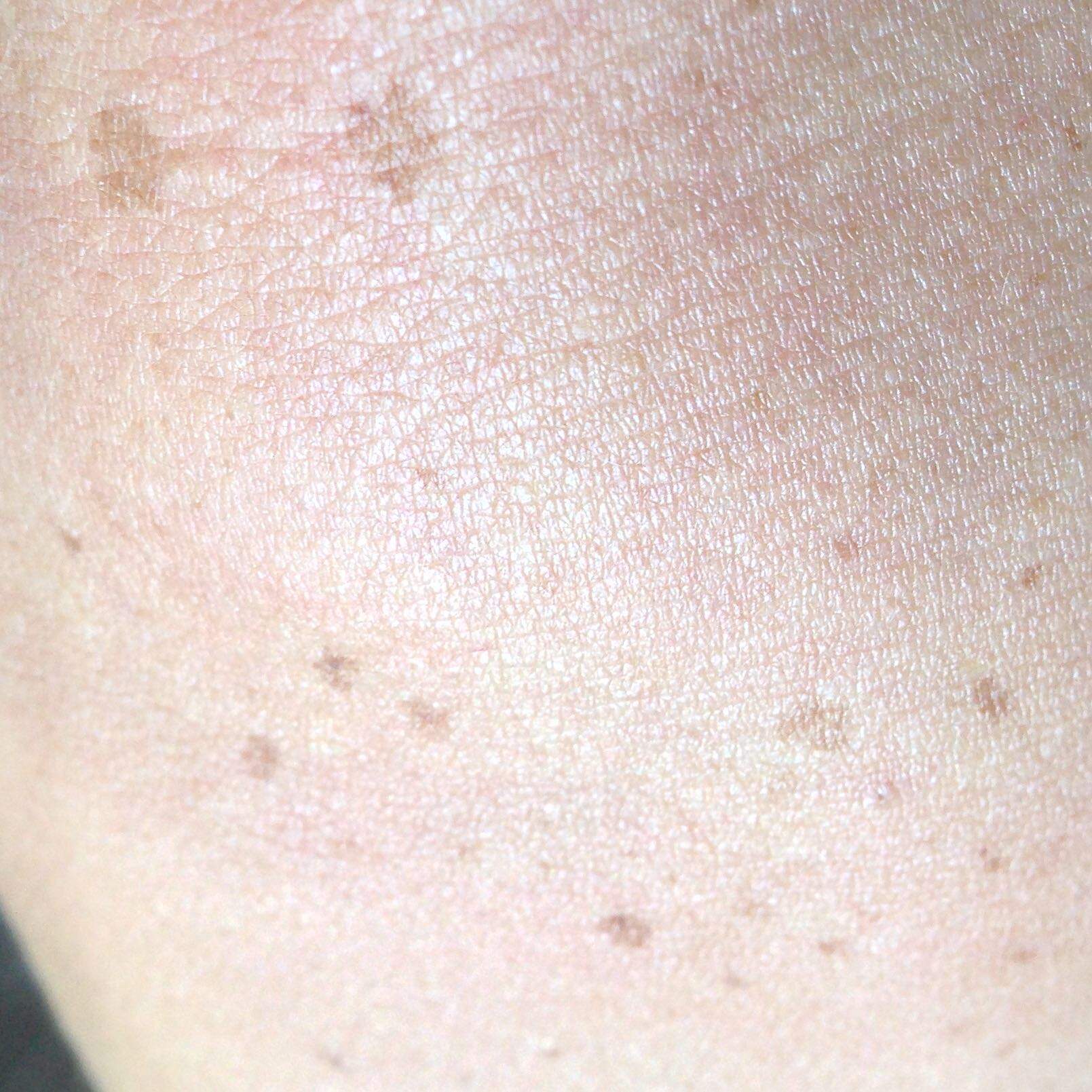 Braune Flecken nach Sonnenbrand Hautkrebs? (Haut, Hautirritation)