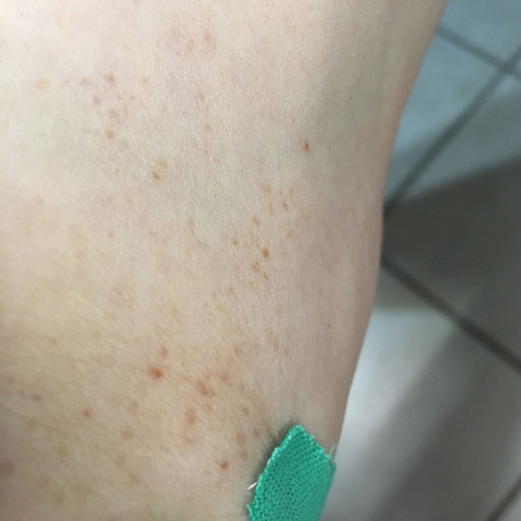 Braune Punkte Am Fuss Aufeinmal Gesundheit Und Medizin Diabetes Braune Punkte Am Fuss Aufeinmal Gesundheit Und Medizin Diabetes