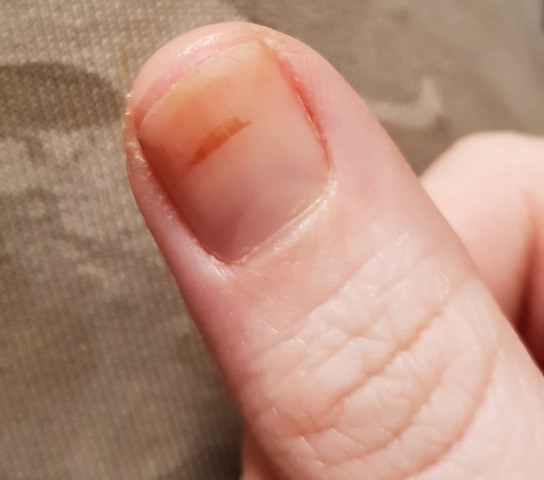 Braune Streifen Unter Beiden Daumennageln Gesundheit Braune Streifen Unter Beiden Daumennageln Gesundheit