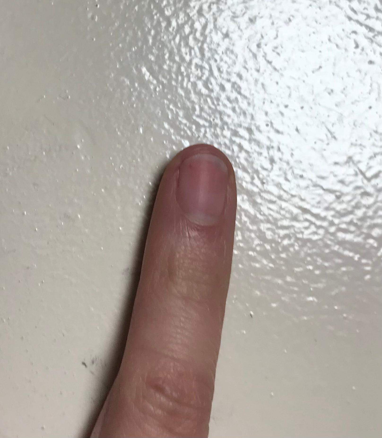 Braune Striche auf den Nägeln, löst