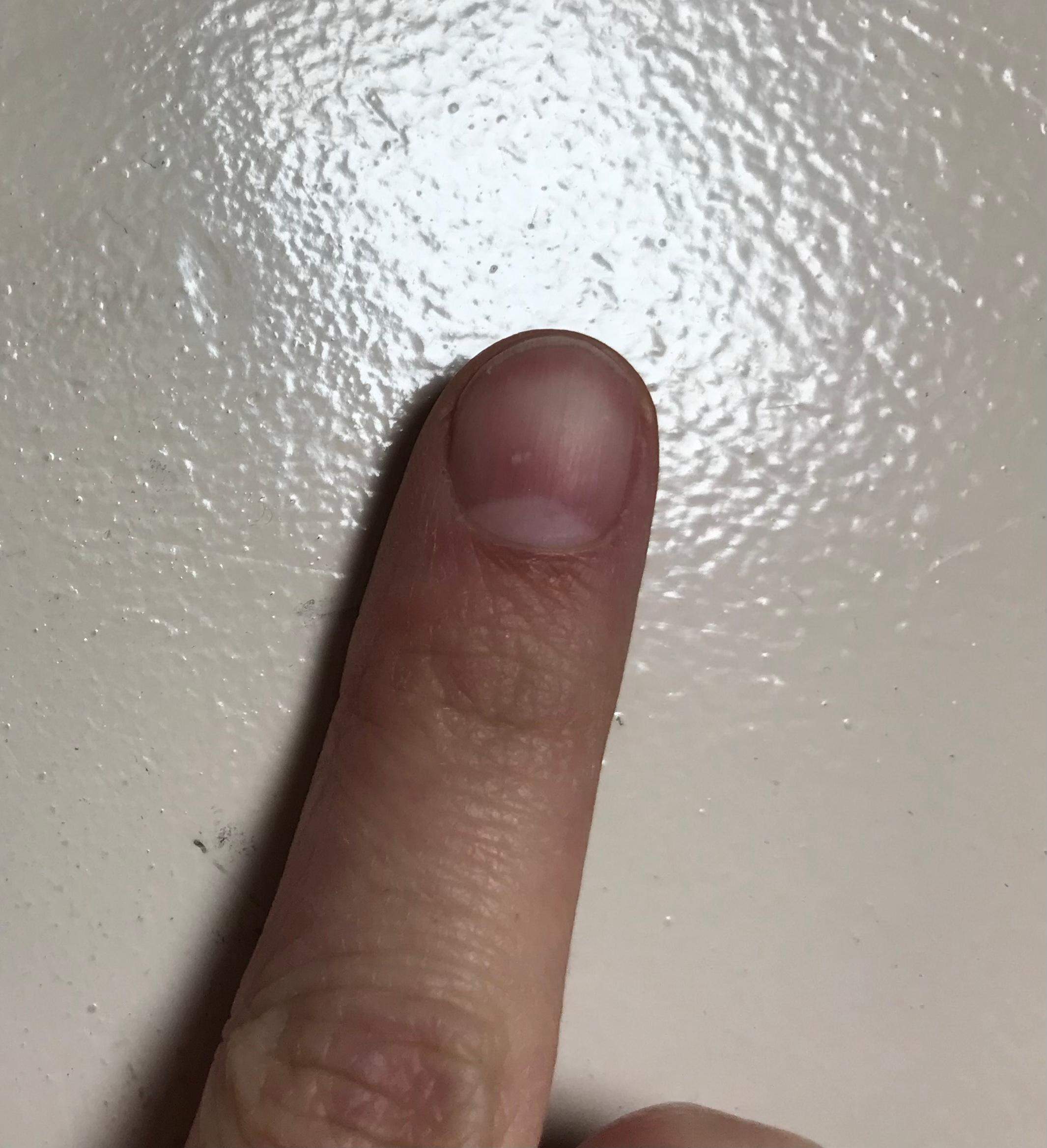Braune Striche auf den Nägeln, löst sich vom Nagelbett? (Beauty, Aussehen, Schönheit)