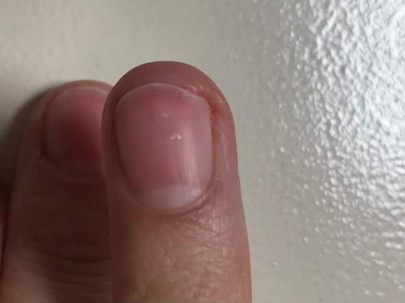 Braune Striche Auf Den N geln L st Sich Vom Nagelbett Beauty braune-striche-auf-den-n-geln-l-st-sich-vom-nagelbett-beauty