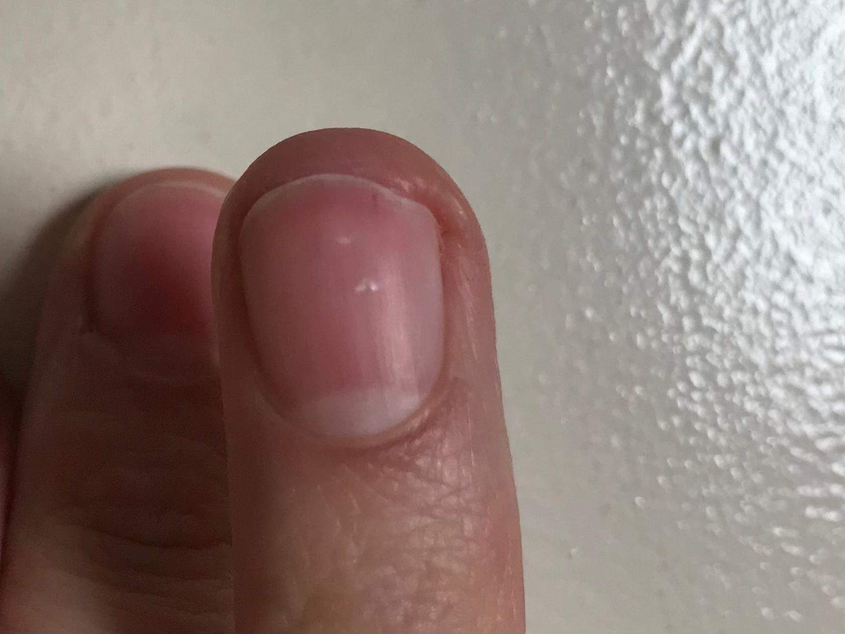 Braune Striche auf den Nägeln, löst sich vom Nagelbett? (Beauty, Aussehen, Schönheit)