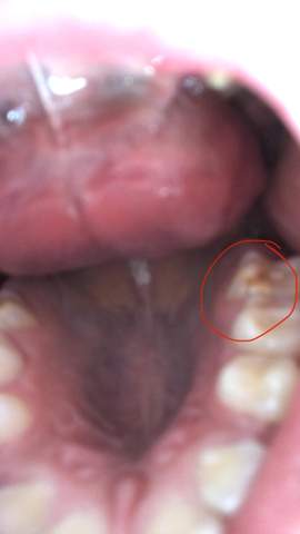 Braune und weiße Flecken auf den Zähnen (Foto)? (Gesundheit und Medizin