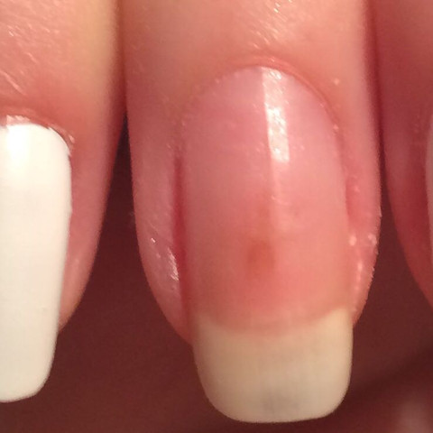 Brauner Fleck Am Fingernagel Flecken Braun Fingernagel