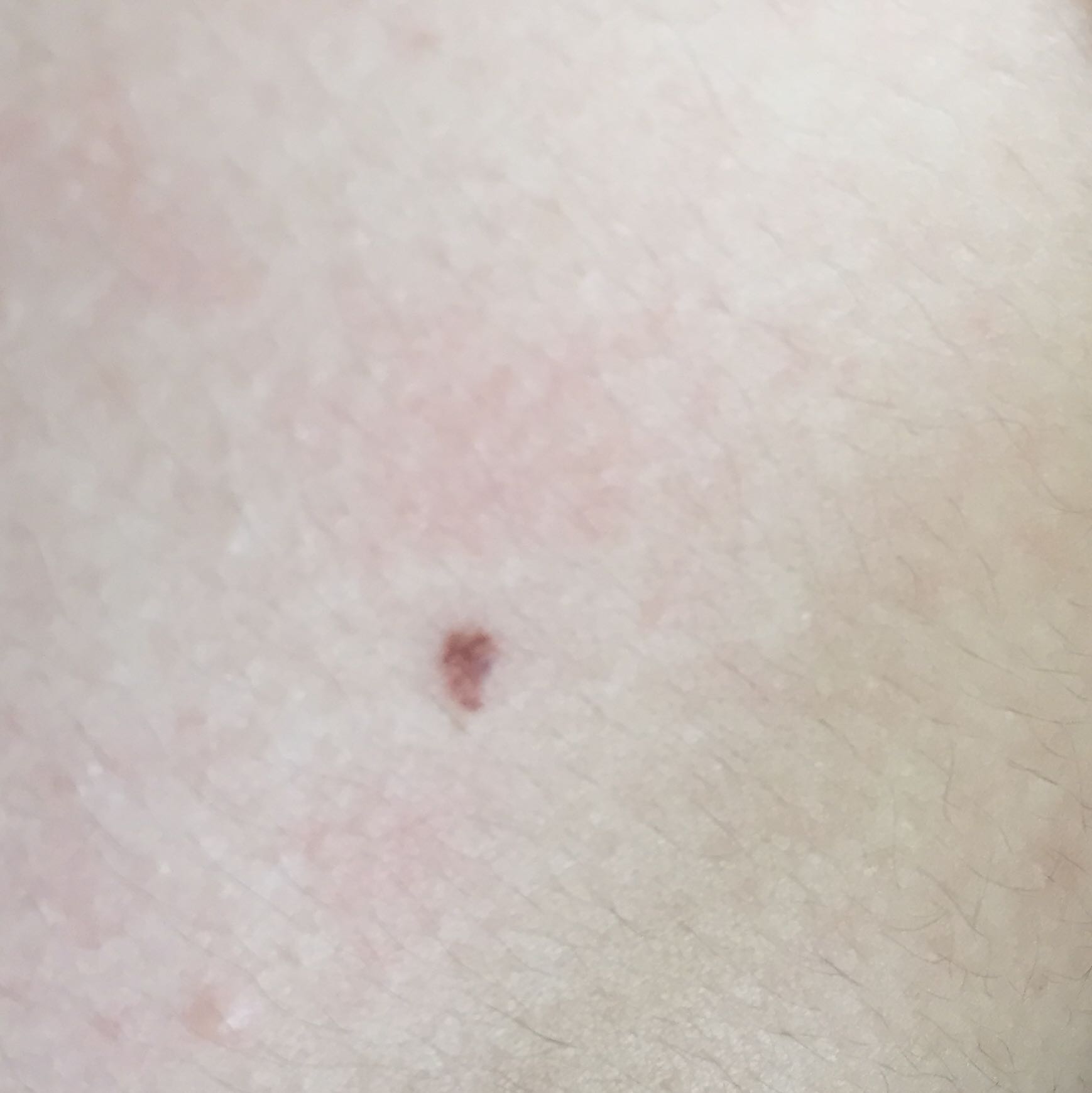 Brauner Fleck an der Brust? (Arzt, Krankheit, Haut) Brauner Fleck an der Brust? (Arzt, Krankheit, Haut)