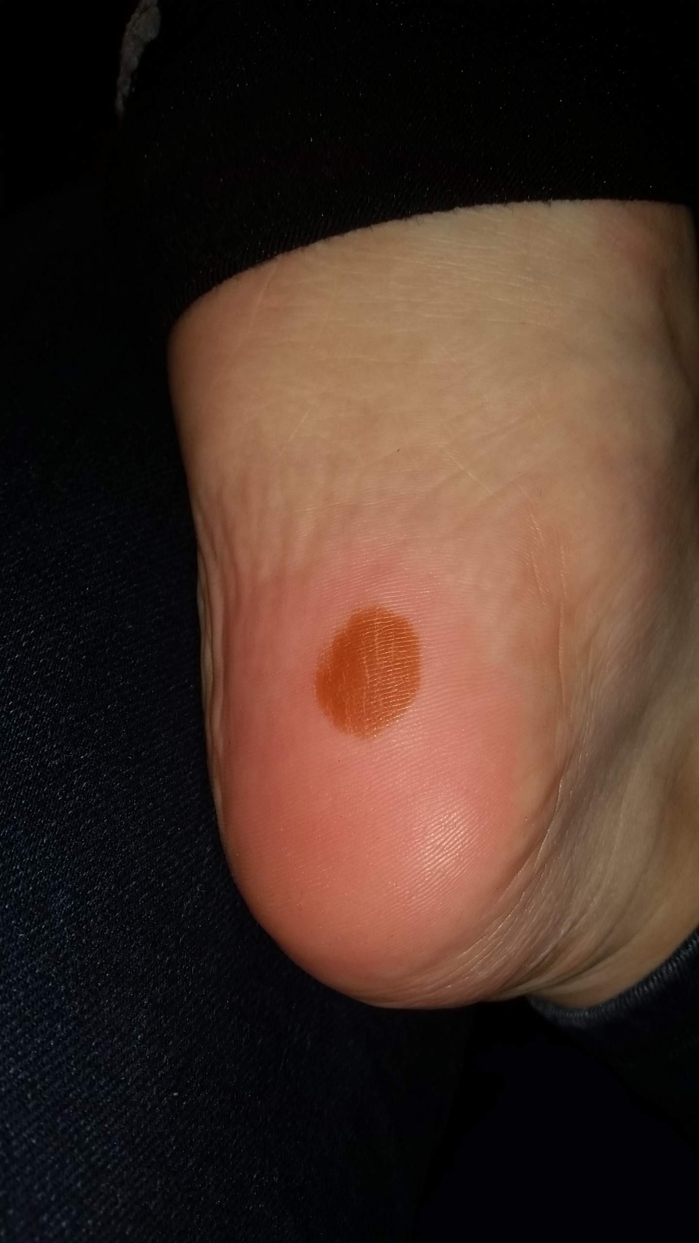 Brauner Fleck an Fußsohle? (Gesundheit und Medizin, Medizin, gefährlich)