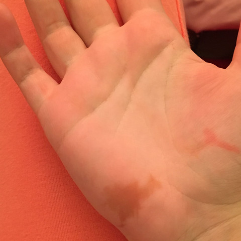 Flecken handfläche braune Hautflechte: Symptome