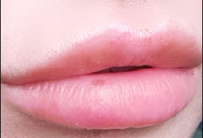 Der flecken lippe auf Lippengeschwüre, Lippenentzündungen