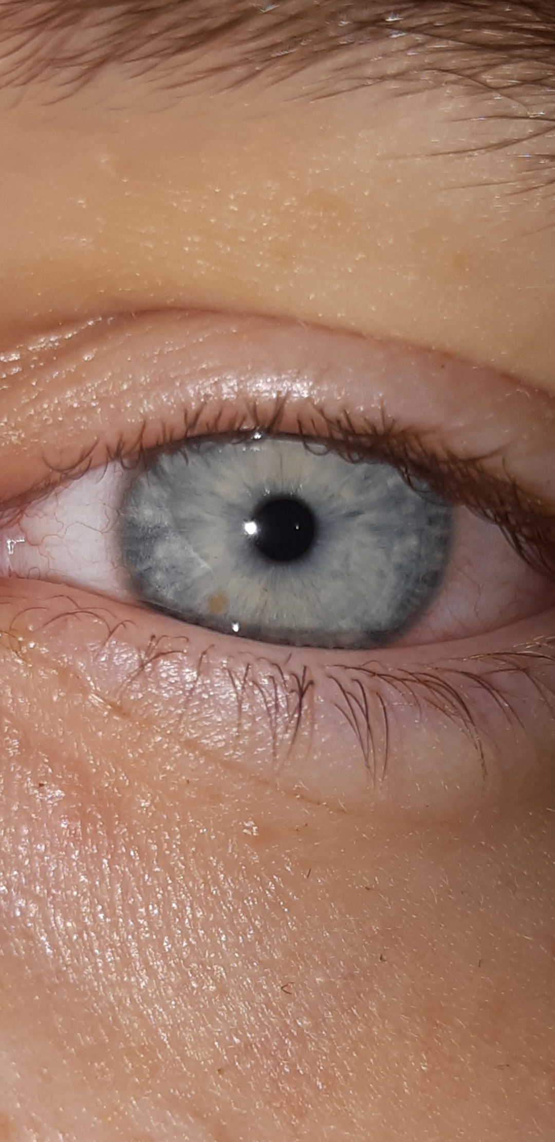 Brauner Fleck beim Auge, was könnte das sein? (Augen)