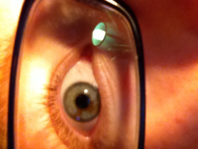 Brauner Fleck in der Iris? (Gesundheit, Augen)
