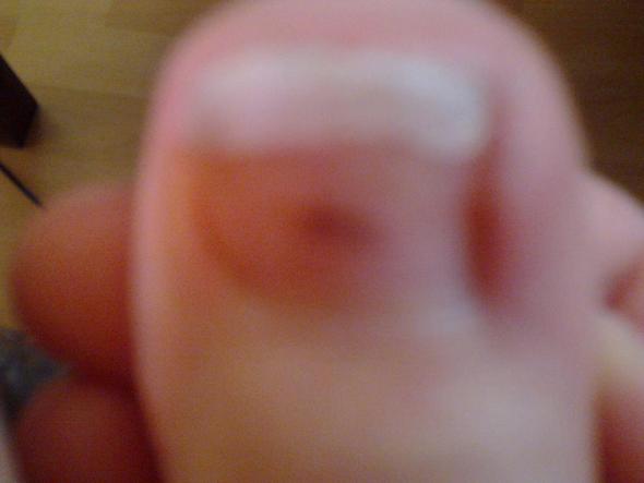 brauner fleck unter dem fussnagel fusse flecken braun