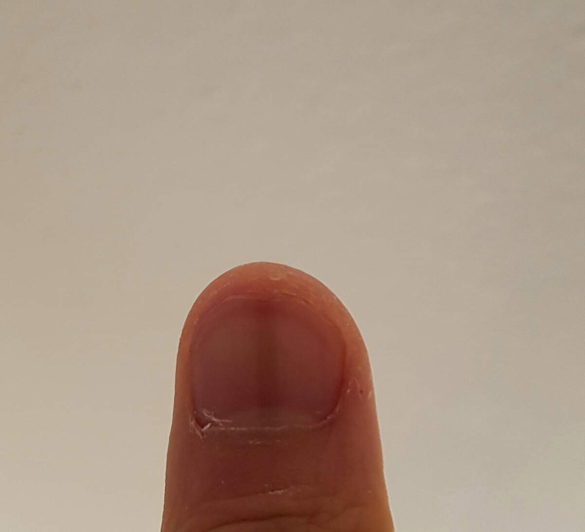 Brauner länglicher Strich am Fingernagel Bedeutung? (Gesundheit, Menschen, Körper)