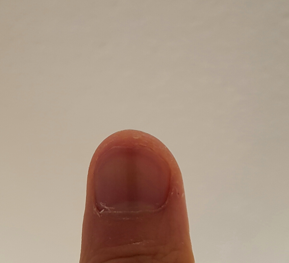 Brauner länglicher Strich am Fingernagel Bedeutung? (Gesundheit, Körper, Menschen) Brauner länglicher Strich am Fingernagel Bedeutung? (Gesundheit, Körper, Menschen)