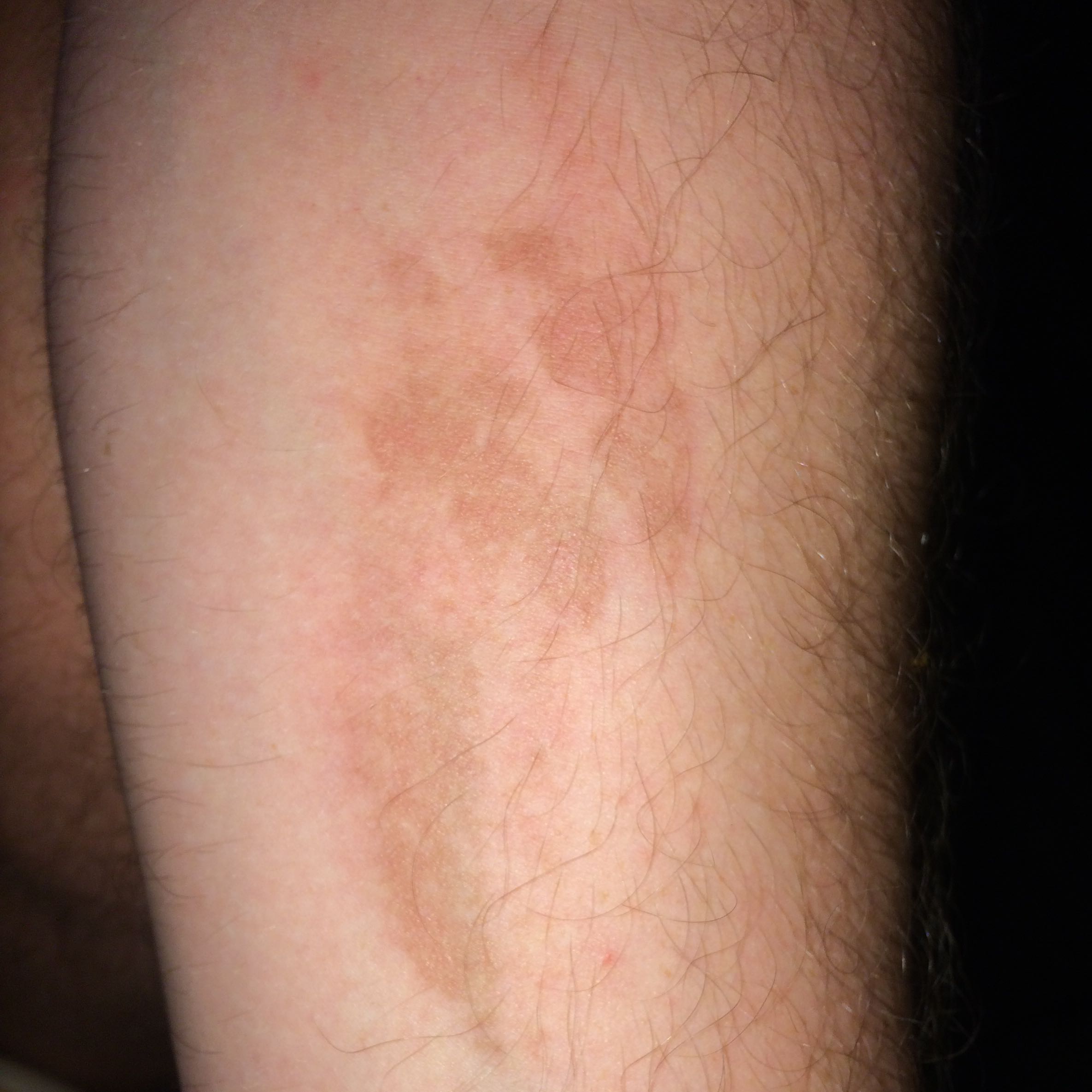 Brauner Pigmentfleck plötzlich da? (Gesundheit und Medizin ...