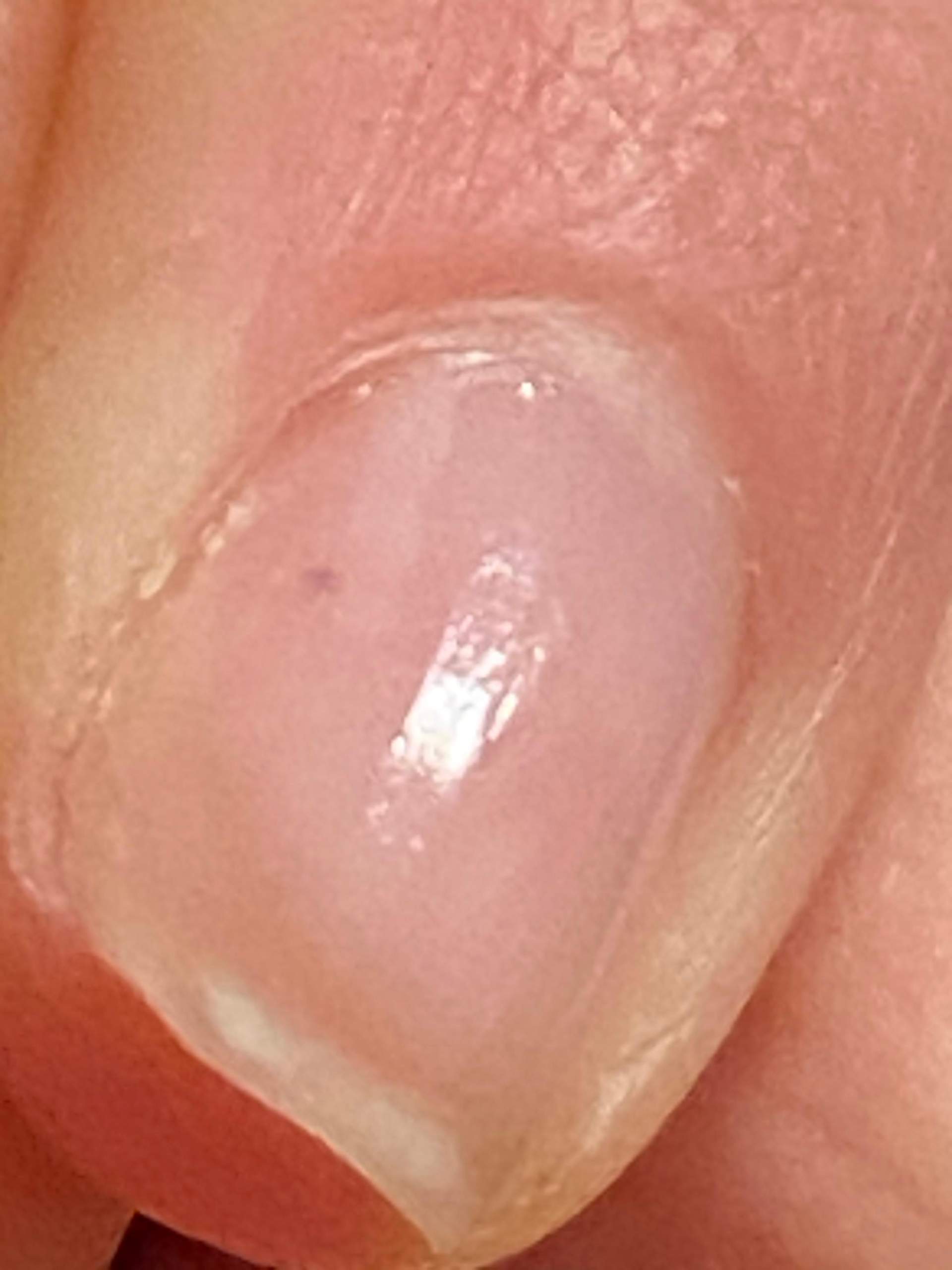 Brauner Punkt unter dem Nagel? (Gesundheit, Nägel, Hand)