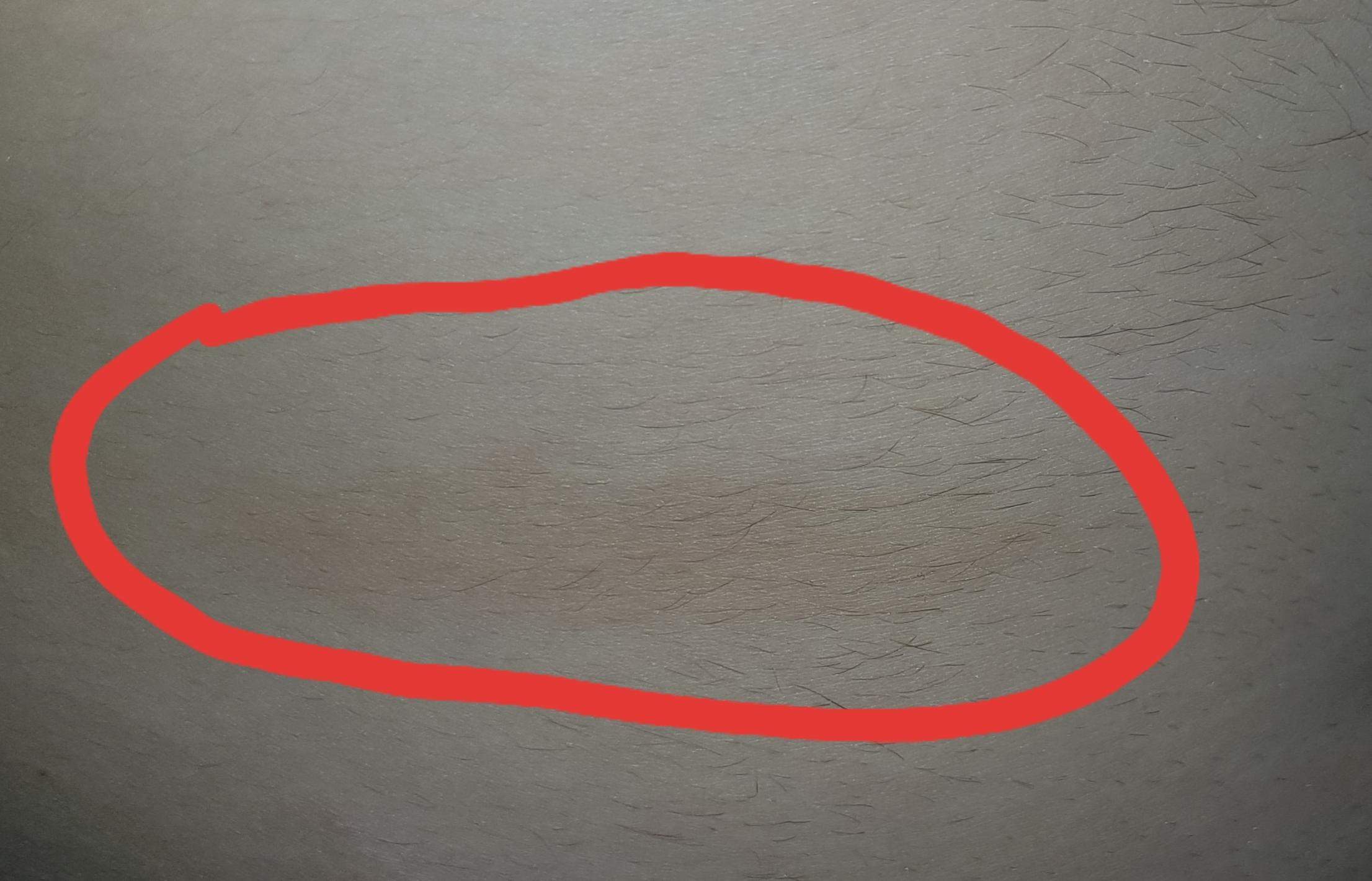 Brauner/blauer fleck am bauch? (Gesundheit und Medizin, Gesundheit, Flecken) Brauner/blauer fleck am bauch? (Gesundheit und Medizin, Gesundheit, Flecken)