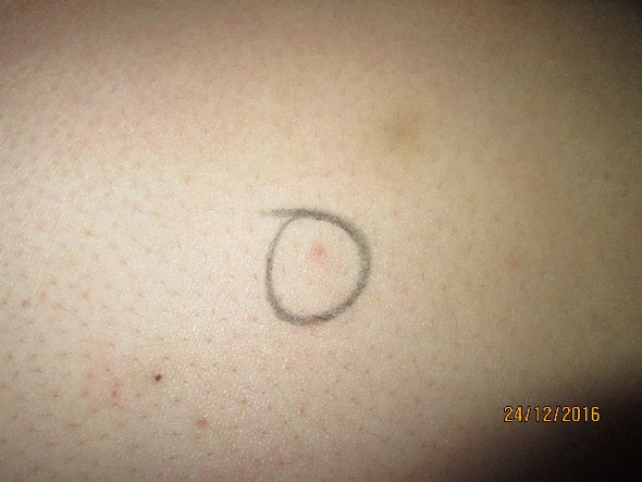 Brennen Am Bauch Und Verteilt Pusteln Gesundheit Medizin Haut Brennen Am Bauch Und Verteilt Pusteln Gesundheit Medizin Haut