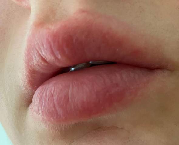 Brennende Rote Krustige Lippen Gesundheit Und Medizin Brennen Lippe