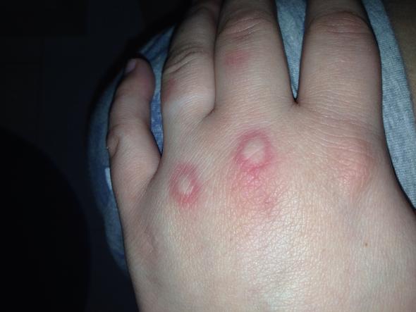 Linke Hand - (Schmerzen, Hand, Flecken)