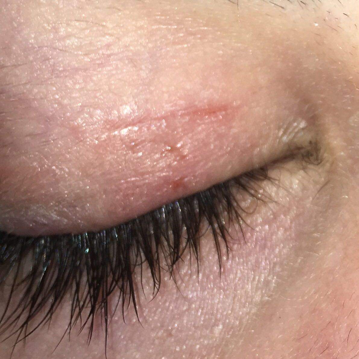Brennende Wunde am Augenlid? (Gesundheit, Augen, brennen)