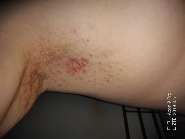 Brennender Ausschlag In Der Achselhohle Gesundheit Und Medizin Medizin Haut Brennender Ausschlag In Der Achselhohle Gesundheit Und Medizin Medizin Haut