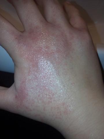 Meine Hand - (Hand, Hautausschlag, gereitzte Haut)