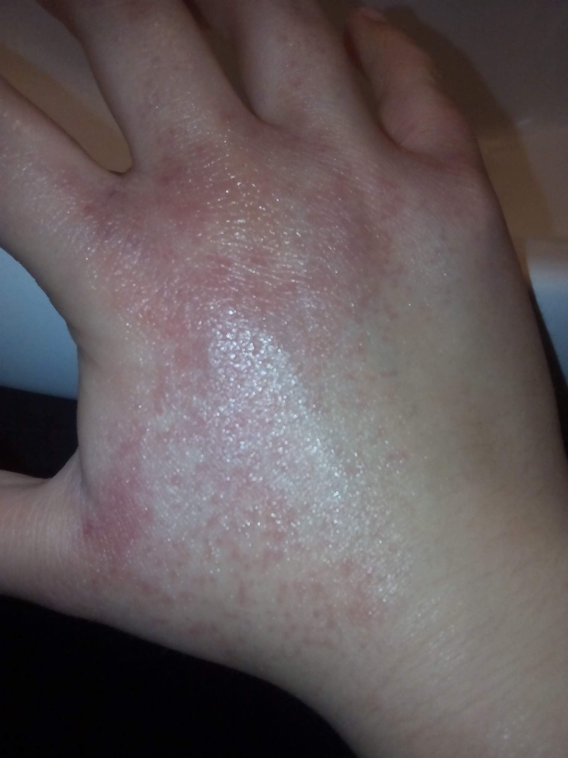 Brennender Hautausschlag ( (Hand) Brennender Hautausschlag ( (Hand)