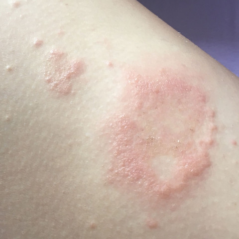 Brennender Juckreiz Was Tun Was Kann Das Sein Ausschlag Brennender Juckreiz Was Tun Was Kann Das Sein Ausschlag