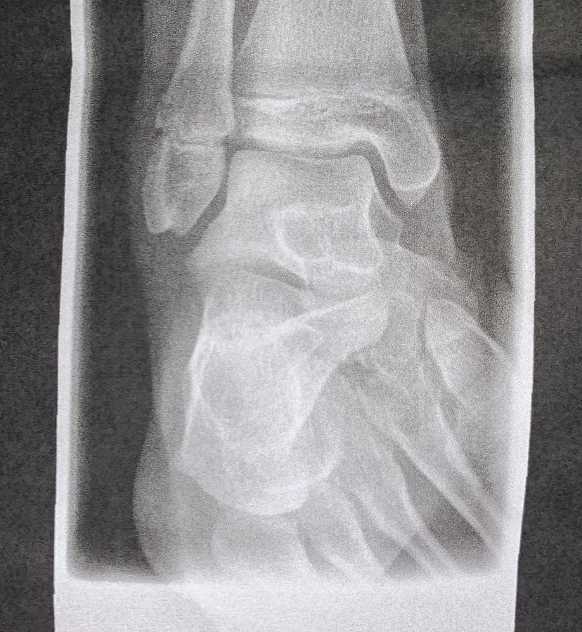 Bruch Oder Gerissen Dauer Fusse Heilungsdauer Gebrochener Fuss Bruch Oder Gerissen Dauer Fusse Heilungsdauer Gebrochener Fuss